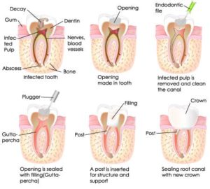 root canal treatment